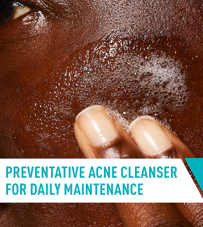 acne-control-cleanser-apply-desktop-700x785-v1.jpg