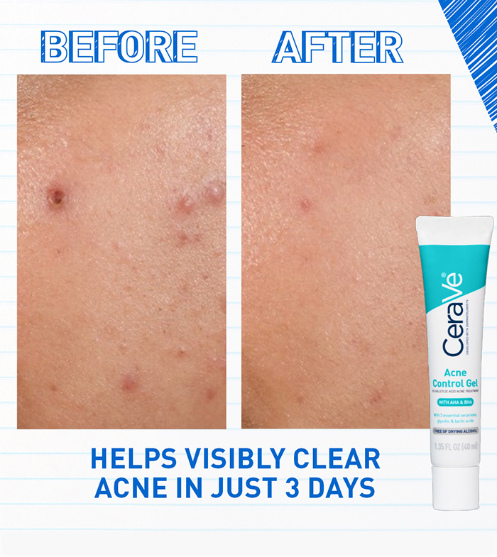 acne-control-gel-ba2-desktop-700x785-v1.jpg